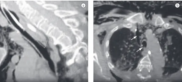 Figure 2 - CT scan of the chest revealing the lesion in the membranous portion of the distal trachea, as well  as pneumomediastinum and subcutaneous emphysema.