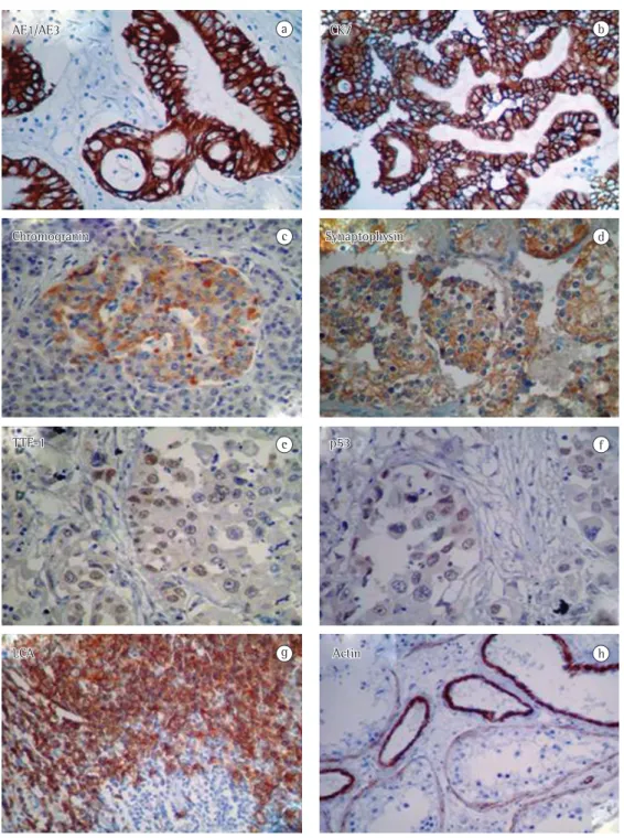 Figure  1  -  Immunohistochemistry  panel  used  in  the  routine  diagnosis  of  lung  cancer