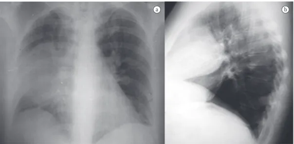 Figura 1 - Radiografia póstero-anterior (a) e lateral direita (b) de tórax, revelando opacificação do andar médio  do campo pulmonar direito, de limites arredondados, e localização anterior, no perfil.