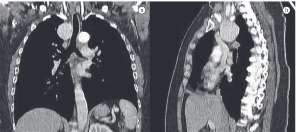 Figura 3 - TC póstero-anterior (a) e lateral direita (b) de tórax apresentando formação tumoral com 4,5 × 4,3 cm,  localizada  no  mediastino  superior,  arredondada,  de  limites  mal  definidos  e  sem  sinais  de  infiltração  das  estruturas adjacentes