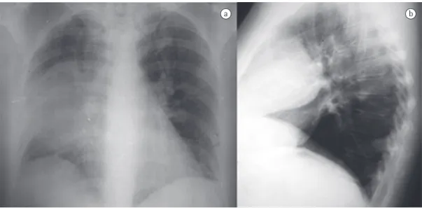Figure 1 - Anteroposterior and right lateral chest X-ray revealing opacification of the middle zone of the right  lung field, with round borders and in an anterior location, in profile.