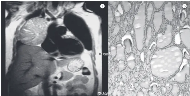 Figure 2 - Magnetic resonance imaging of the chest (on the left) and histology of the surgical sample (on the  right)