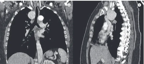 Figure 3 - Chest CT scan showing a round tumor formation (4.5 × 4.3 cm) in the upper mediastinum, with  well-defined borders and without signs of infiltration of adjacent structures.