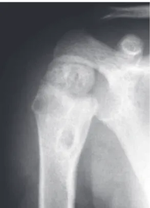 Figura 1 - Radiografia do úmero proximal indicando  lesões osteolíticas com esclerose periférica na metáfise  e epífise umeral