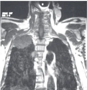 Figura 2 - Tumor de Pancoast. Ressonância magnética  de tórax em corte coronal, exibindo o acometimento  costal, com importante erosão óssea.