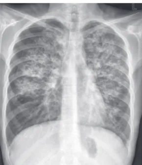 Figura  1  -  Radiografia  de  tórax  mostrando  pneumotórax bilateral e infiltração intersticial bilateral  causados pela fibrose cística.