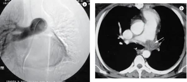 Figure 1 - Angiography (a) and CT (b) of the pulmonary artery showing the thrombus completely occluding  the left branch of the pulmonary artery.