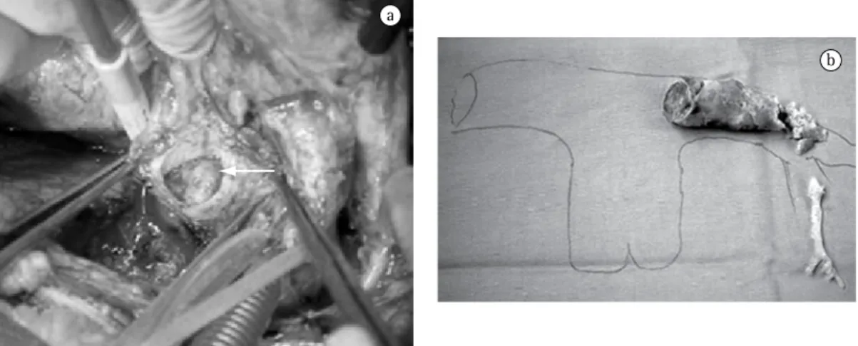 Figure 2 - Intra-operative view of the open pulmonary artery, showing the thrombus completely occluding the  left branch of the pulmonary artery (a) and the thrombus after removal (b).