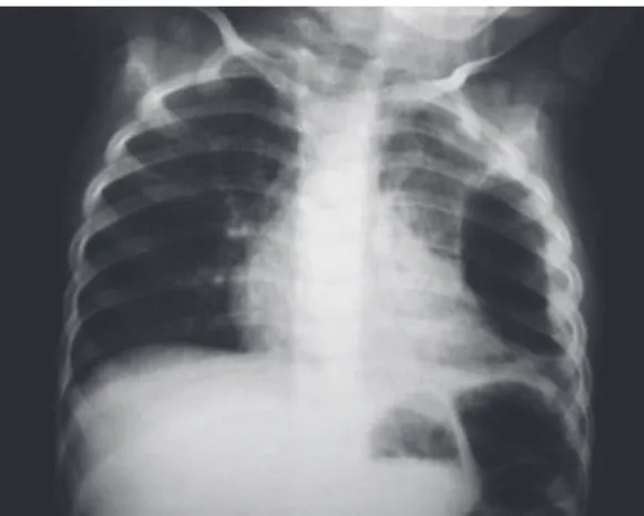 Figure  2  -  Axial  chest  CT  scan  showing  multiple  cavities of various sizes, as well as pneumothorax, in  the middle and lower third of the left hemithorax.