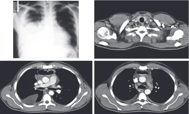 Figure 1 - Initial imaging studies (X-ray and CT scans) revealing right pleural effusion and diffuse mediastinal  collection with air-fluid levels, initiating at the left common carotid artery sheath (Case 1)