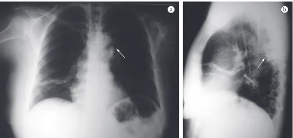 Figure 1 - Chest X-rays: anteroposterior (in a) and lateral (in b), revealing a mass projecting into the left hilar  region (arrow in a) located in the posterior mediastinum (arrow in b), as well as an atelectatic band in the  middle lobe.