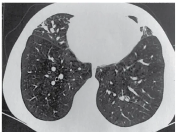 Figure  1  -  Chest  CT  scan  showing  opacities  in  the  middle  lobe  and  in  the  inferior  segment  of  the  lingula.