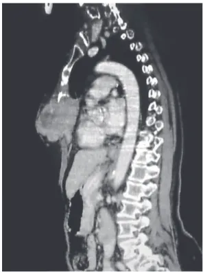 Figura  1  -  TC  de  tórax  demonstrando  uma  lesão  lítica,  insuflativa,  excêntrica,  com  afinamento  ou  erosão da cortical, com medidas de 12 × 7,5 × 4,5 cm  acometendo o esterno.
