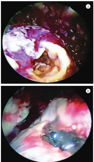 Figura 1 - Imagens obtidas durante a toracoscopia,  revelando necrose do parênquima pulmonar.