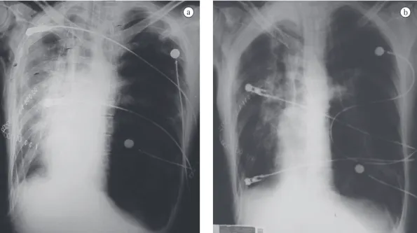 Figure 1 - In a), chest X-ray after single lung transplantation. Note native lung hyperinflation, mediastinal  shift, flattening of the diaphragmatic dome and compression of the graft