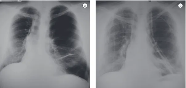 Figure 2 - In a), chest X-ray three years after right lung transplantation. Note native lung hyperinflation and  mediastinal shift to the right