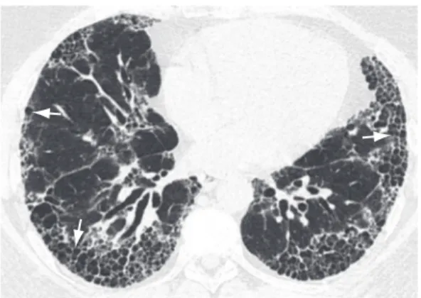 Figura  28  -   Fibrose  maciça  progressiva  (seta)  em  paciente  com  pneumoconiose  dos  mineiros  de  carvão.