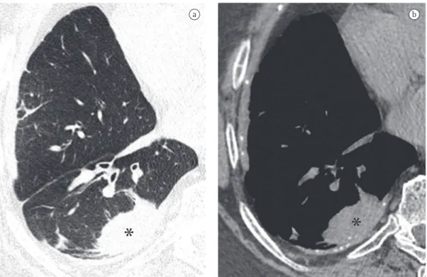 Figura  5  -  Cortes  axiais  de  TCAR  de  tórax  reconstruídos  com  algoritmos  para  a  avaliação  do  parênquima  pulmonar (em a) e do mediastino (em b), revelando atelectasia redonda (asteriscos) em paciente exposto ao  asbesto