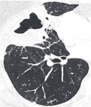 Figura  16  -  Cistos  pulmonares  (setas)  em  paciente  com linfangioliomiomatose.