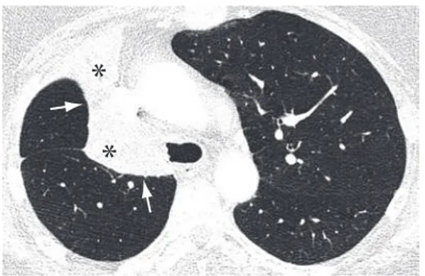 Figure 3 - Axial CT slice of the chest with iodinated  contrast material, revealing air bronchograms (arrows)  in areas of lung parenchyma with atelectasis (1) and  consolidation (2)