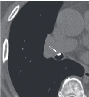 Figure 11 - Axial CT slice of the chest without the use  of contrast material, revealing a broncholith (arrow).