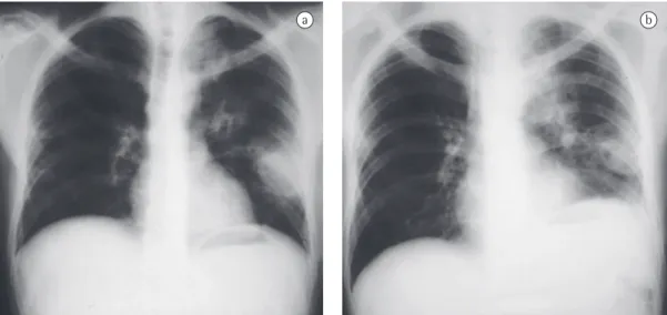 Figura 1 - Radiografia de tórax de um paciente com leucemia, mostrando cavidades (em A) e consolidação  pulmonar (em B) por  Rhizomucor pusillus .