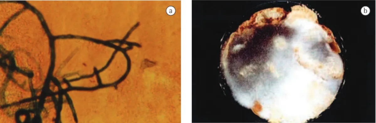 Figure 3 - Sample of bronchial aspirate. In a), hypha branched at 90° (potassium hydroxide with Parker ink; 