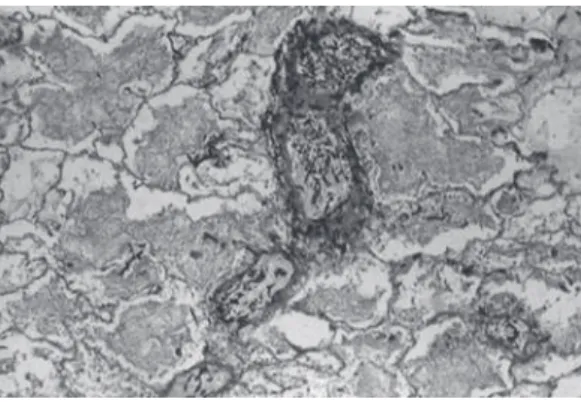 Figure 4 - Angiotropism: lung parenchyma revealing  the  marked  angiotropism  caused  by  Zygomycetes  (Grocott; magnification, ×10).