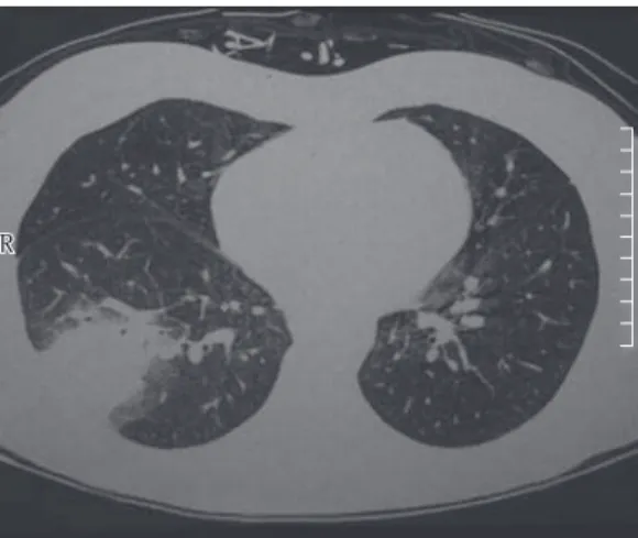 Figure 1 - Fungal pneumonia. The halo sign.