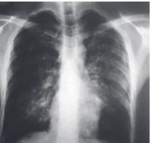 Figura 1 - Radiografia de tórax revelando opacidades  heterogêneas difusas e pneumotórax bilateral.