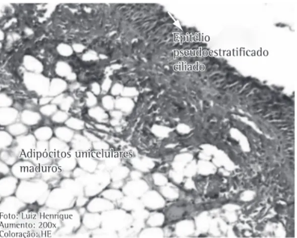 Figura  3  -  Material  histopatológico  mostrando  o  epitélio  pseudoestratificado  ciliado  da  traqueia  e  células adiposas do lipoma.