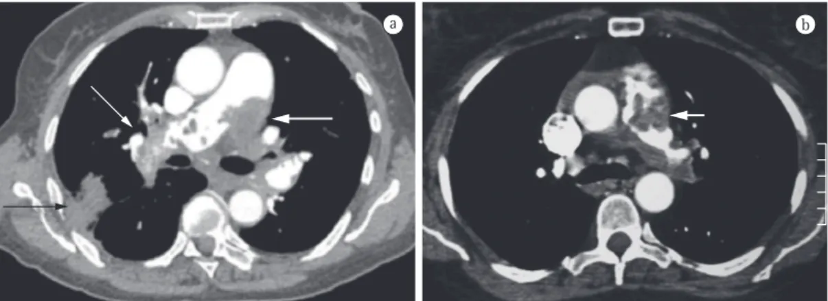 Figura 1 - Em a, angiotomografia de tórax referente ao caso 1 mostrando dilatação da artéria pulmonar e  falhas de enchimento irregulares, notadamente no tronco (seta grossa branca) e no ramo direito da artéria  pulmonar (seta fina branca), conjuntamente c