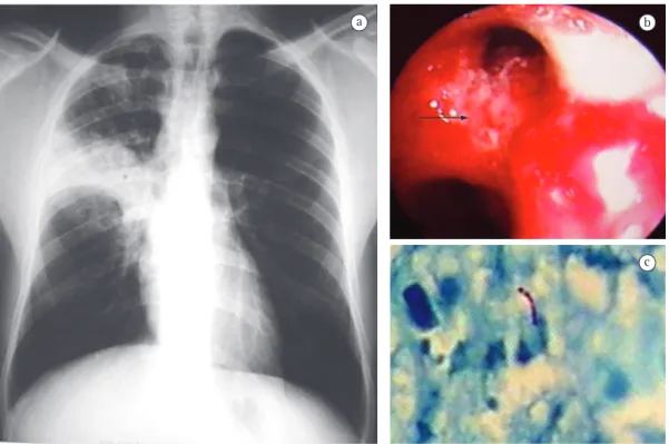 Figure 1 - A 23-year-old, White, HIV-negative male: dry cough for 10 days not followed by purulent or bloody  sputum production; fever (39.4°C), weakness, and weight loss; tuberculin skin test positivity (induration,  13 mm); normal white blood cell count;