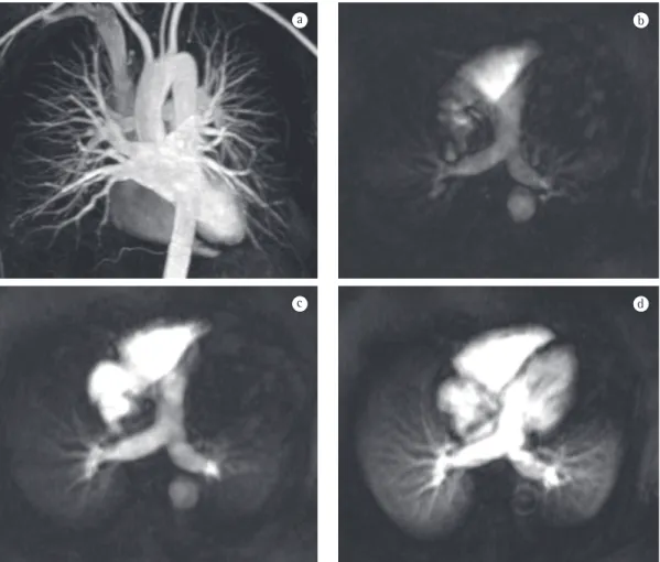 Figura 6 - Imagens de angiorressonância magnética de tórax em um indivíduo saudável. A imagem de  angiografia por reconstrução 3D (a) permite visualizar toda a vasculatura pulmonar, identificando até as artérias  pulmonares subsegmentares