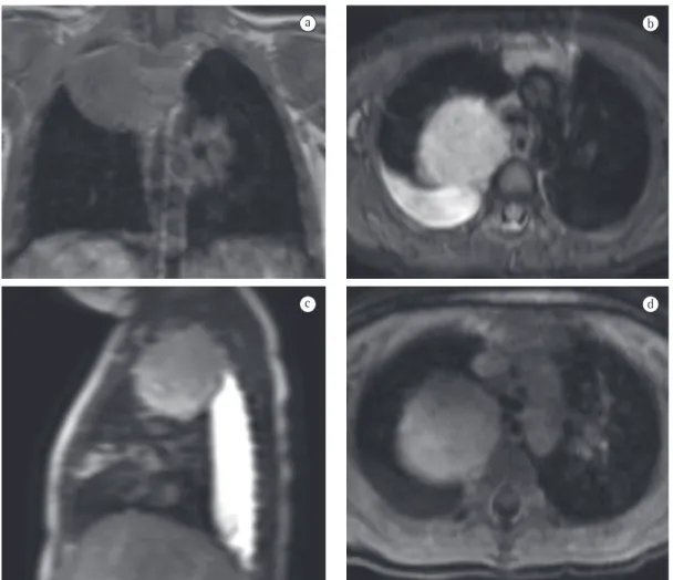 Figura 7 - Imagens de ressonância magnética demonstrando ganglioneuroma. Imagem axial T1 (a), axial  (b), sagital T2 (c) e axial T1 pós-contraste (d)