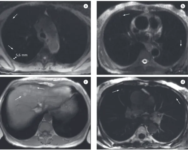 Figura 2 - Imagens de ressonância magnética demonstrando metástases de melanoma. Imagens no plano axial,  ponderadas em T1 (a e c), T2 (b) e T1 pós-contraste (d)