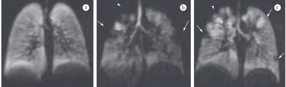 Figura 3 - Imagens volumétricas de ressonância magnética demonstrando fibrose cística no plano coronal,  após inalação de gás  3 He hiperpolarizado