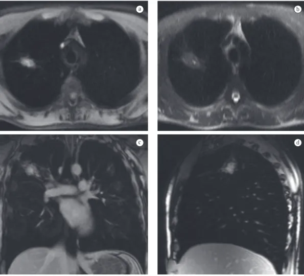 Figura 4 - Imagens de ressonância magnética demonstrando aspergiloma pulmonar. Imagens no plano  axial ponderadas em T1 (a), T2 (b) e sequências T1 pós-contraste coronal (c) e sagital (d)