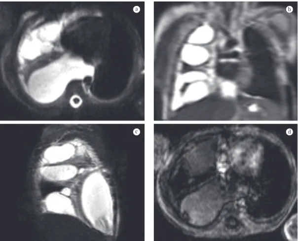 Figura 5 - Imagens de ressonância magnética demonstrando quilotórax. Criança lactente que desde o  nascimento apresentava derrames pleurais de repetição, com análise do liquido pleural demonstrando presença  de linfa