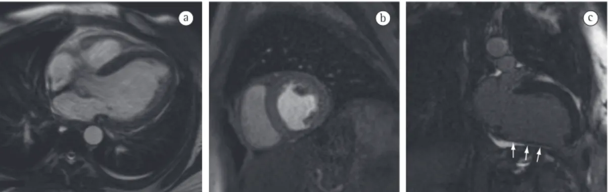 Figure 8 - True fast imaging with steady-state precession cardiac magnetic resonance image (a) of the long  axis of the left ventricle (LV), used for morphological and functional evaluation; dynamic contrast-enhanced  gradient-echo sequence image of the sh
