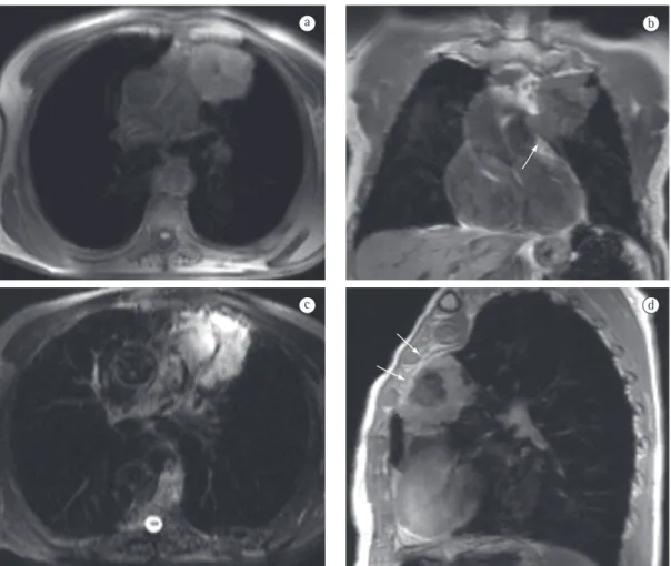 Figure 1 - Magnetic resonance images showing pulmonary epidermoid carcinoma of the lung as a  paramediastinal lesion