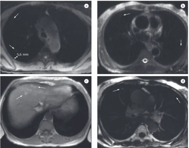 Figure 2 - Magnetic resonance images showing metastases of melanoma. Axial T1-weighted images (a and  c), axial T2-weighted image (b), and axial contrast-enhanced T1-weighted image (d)