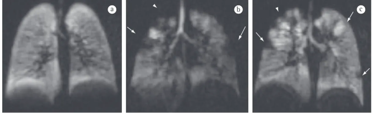 Figure 3 - Volumetric magnetic resonance images after inhalation of hyperpolarized helium showing cystic  fibrosis in the coronal plane in three different young patients with cystic fibrosis, all of whom presented  normal spirometry results