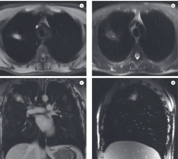 Figure 4 - Magnetic resonance images showing pulmonary aspergilloma. Axial T1-weighted image (a), axial  T2-weighted image (b), coronal contrast-enhanced T1-weighted image (c), and sagittal contrast-enhanced  T1-weighted image (d)