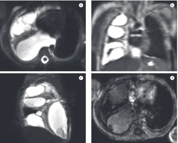 Figure 5 - Magnetic resonance images showing chylothorax in an infant with recurrent pleural effusions since  birth