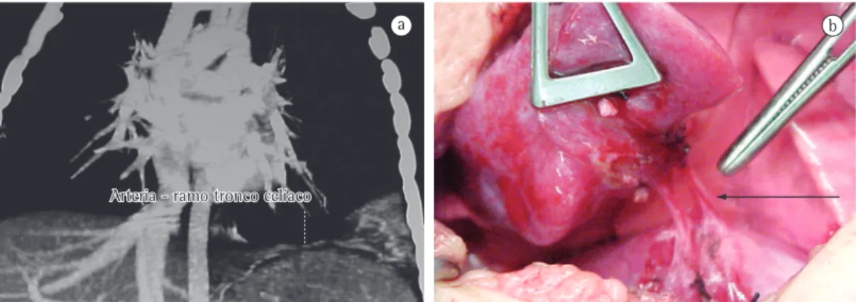 Figura 1 - Sequestração pulmonar extralobar. Em a, TC de tórax demonstrando suprimento arterial de tecido  pulmonar proveniente do tronco celíaco