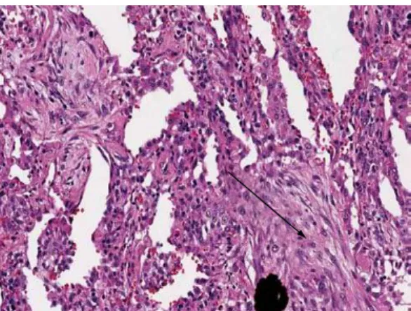 Figura 2 - Biópsia pulmonar de um paciente com  síndrome antissintetase e doença pulmonar intersticial  mostrando infiltrado celular intersticial e pneumonia  em organização (seta).