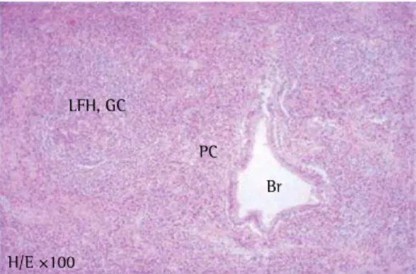 Figure 3 - Photomicrograph of a fragment of the  resected nodule demonstrating a predominance of  plasma cells (PC)