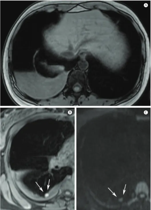 Figure 1 - Magnetic resonance imaging (MRI). In A, axial, T1-weighted, out-phase MRI sequence showing  right hydropneumothorax