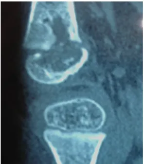 Figura 1 - Ressonância magnética de fêmur direito  demonstrando lesões osteolíticas.